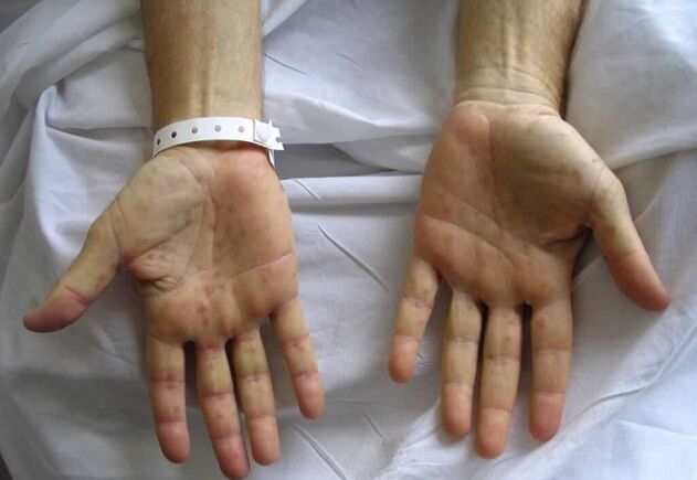 مرض الزهري على اليدين كسبب للإفرازات المرضية من القضيب